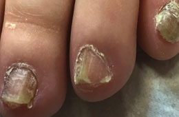 Hollywood Peel and fungal nail infection