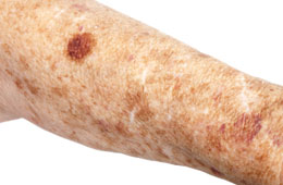 pigment, brown spots, age spots