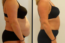 fat freezing and skin tightening