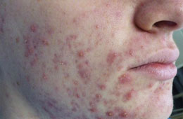 acne and scar reductions