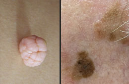 skin tags and moles